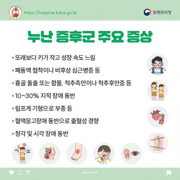 누난 증후군이란