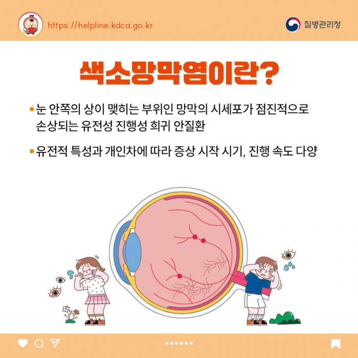 색소망막염