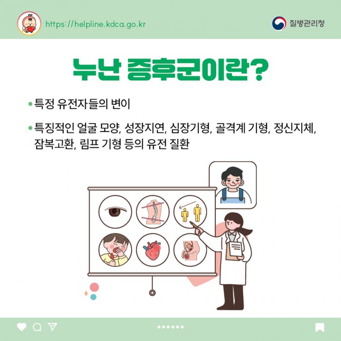 누난 증후군이란