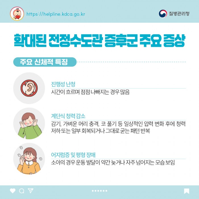 확대된 전정수도관 증후군