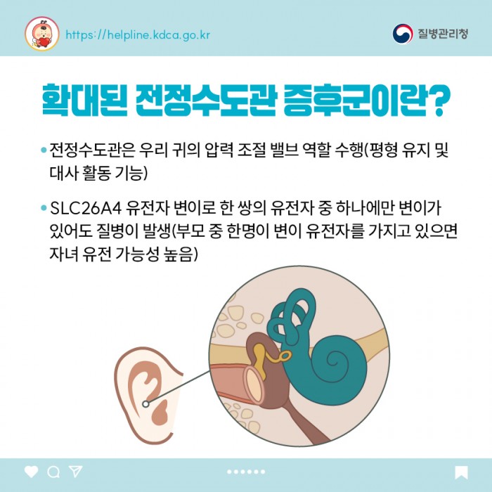 확대된 전정수도관 증후군