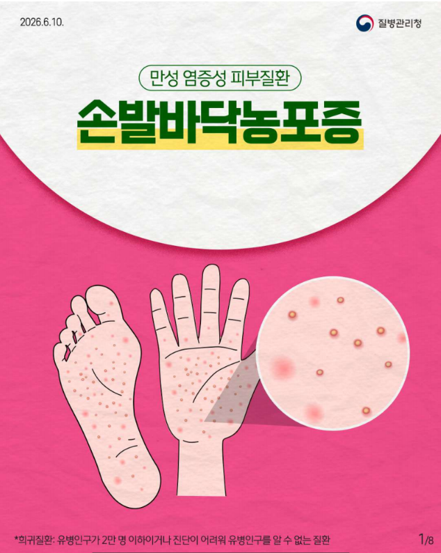 희귀질환 바로알기, 만성 염증성 피부질환 '손발바닥농포증'