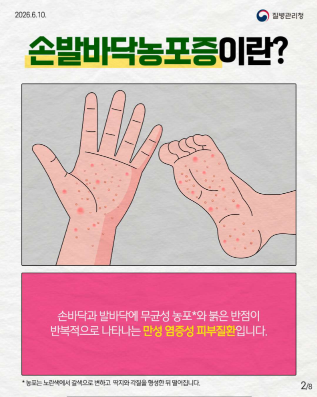 희귀질환 바로알기, 만성 염증성 피부질환 '손발바닥농포증'