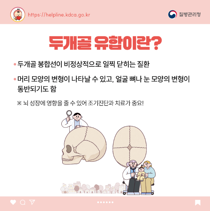 소아청소년 희귀질환 카드뉴스-두개골 유합