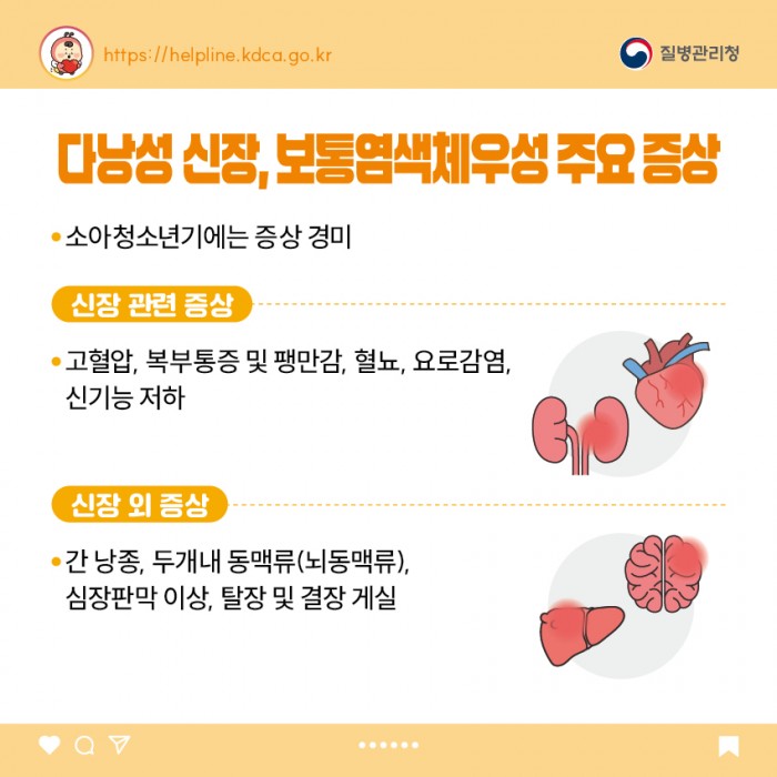 다낭성 신장, 보통염색체우성