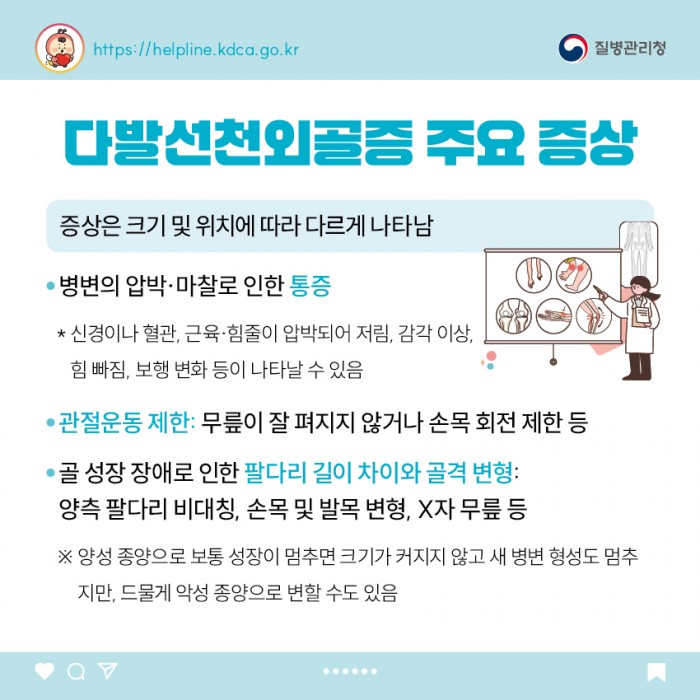 희귀질환 - 다발선천외골증