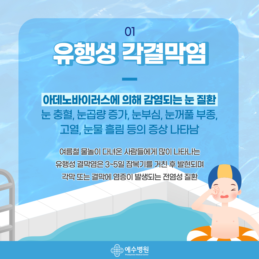 01 - 유행성 각결막염. 아데노바이러스에 의해 감염되는 눈질환-눈충혈, 눈곱량증가, 눈부심, 눈꺼풀 부종, 고열, 눈물 흘림 등의 증상 나타남- 여름철 물놀이 다녀온 사람들에게 많이 나타나는 유행성 결막염은 3~5일 잠복기를 거친 후 발현되며 각막 또는 결막에 염증이 발생되는 전염성질환