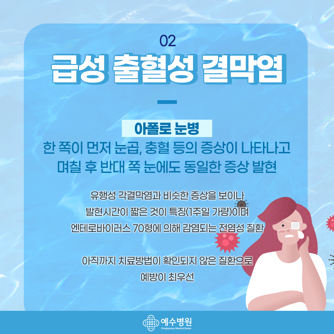 02 - 급성 출혈성 결막염. 아폴로 눈병-한 쪽이 먼저 눈곱, 충혈 등의 증상이 나타나고 며칠 후 반대 쪽 눈에도 동일한 증상 발현 유행성 각 결막염과 비슷한 증상을 보이나 발현시간이 짧은 것이 특징 (1주일 가량)이며 엔테로바이러스 70형에 의해 감염되는 전염성 질환 아직까지 치료방법이 확인되지 않은 질환으로 예방이 최우선