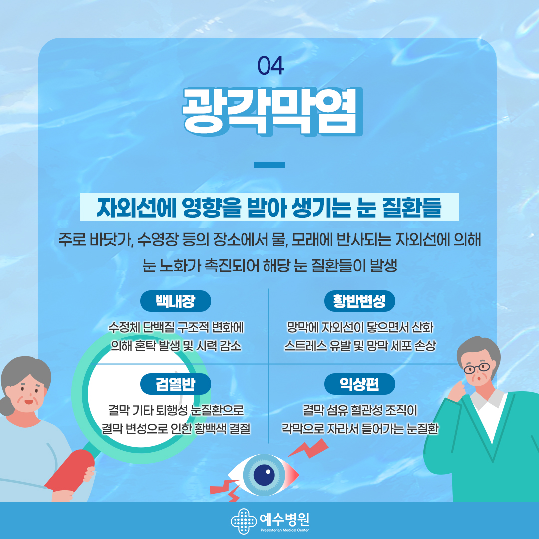 04 - 광각막염. 자외선에 영향을 받아 생기는 눈 질환들 - 주로 바닷가, 수영장 등의 장소에서 물, 모래에 반사되는 자외선에 의해 눈 노화가 촉진되어 해당 눈 질환들이 발생. 백내장:수정체 단백질 구조적 변화에 의해 혼탁 발생 및 시력 감소, 황반변성:망막에 자외선이 닿으면서 산화 스트레스 유발 및 망막 세포 손상, 검열반: 결막 기타 퇴행성 눈질환으로 결막 변성으로 인한 황백색 결절, 익상편: 결막 섬유 혈관성 조직이 각막으로 자라서 들어가는 눈질환