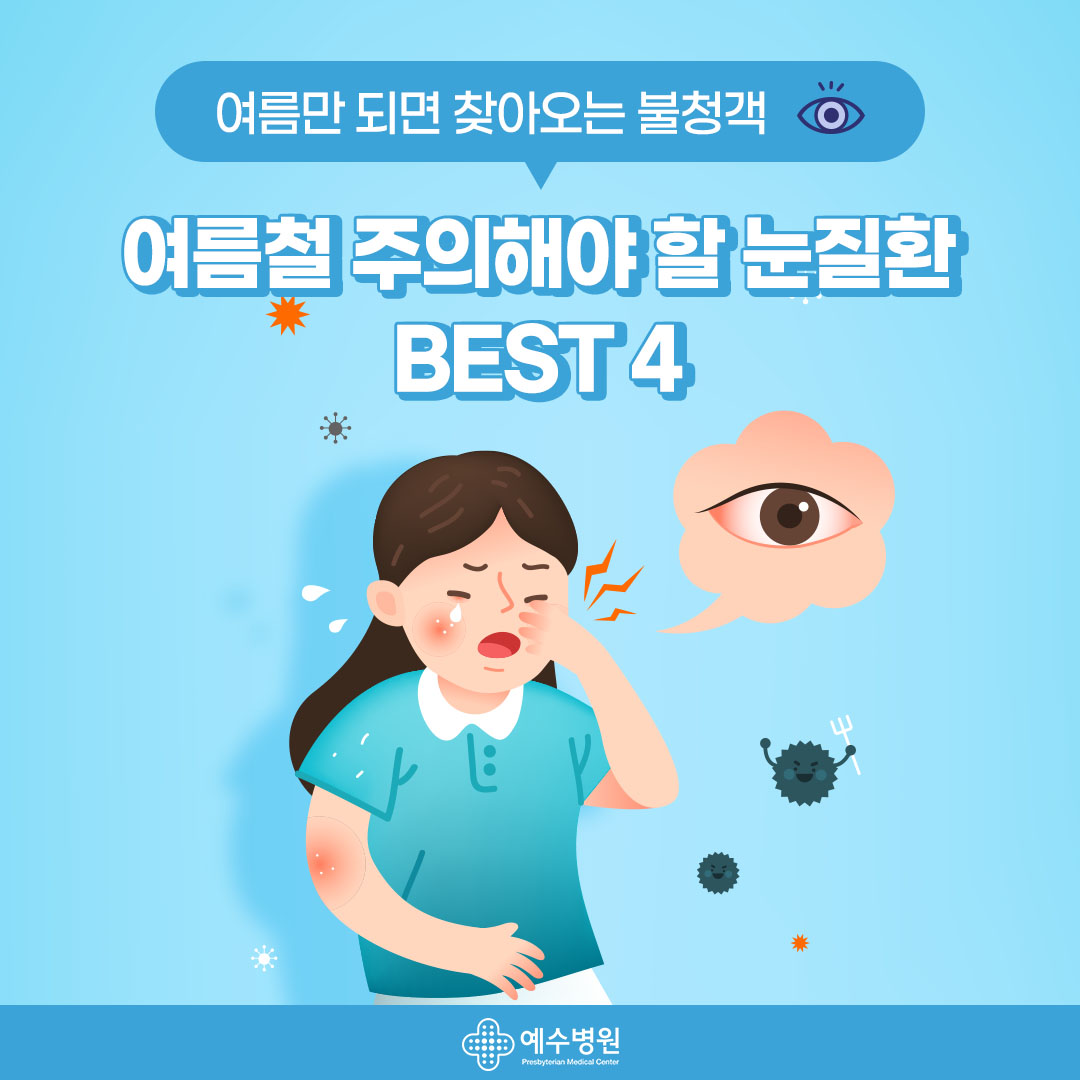 여름만 되면 찾아오는 불청객- 여름철 주의해야 할 눈질환 BEST4