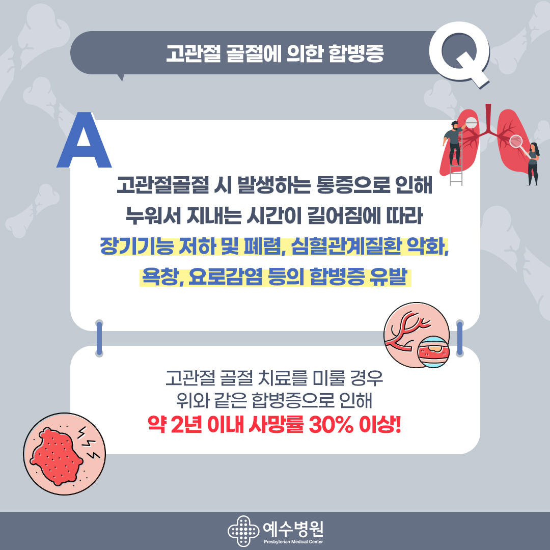 고관절 골절에 의한 합병증 - 고관절 골절시 발생하는 통증으로 인해 누워서 지내는 시간이 길어짐에 따라 장기기능 저하 및 폐렴, 심혈관계질환 악화, 욕창, 요로감염 등의 합병증 유발- 고관절 골절 치료를 미룰 경우 위와 같은 합병증으로 인해 약 2년 이내 사망률 30% 이상!