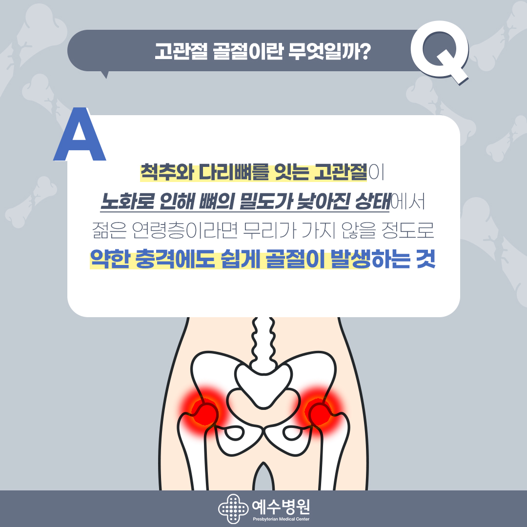 고관절 골절이란 무엇일까? 척추와 다리뼈를 잇는 고관절이 노화로 인해 뼈의 밀도가 낮아진 상태에서 젊은 연령층이라면 무리가 가지 않을 정도로 약한 충격에도 쉽게 골절이 발생하는 것