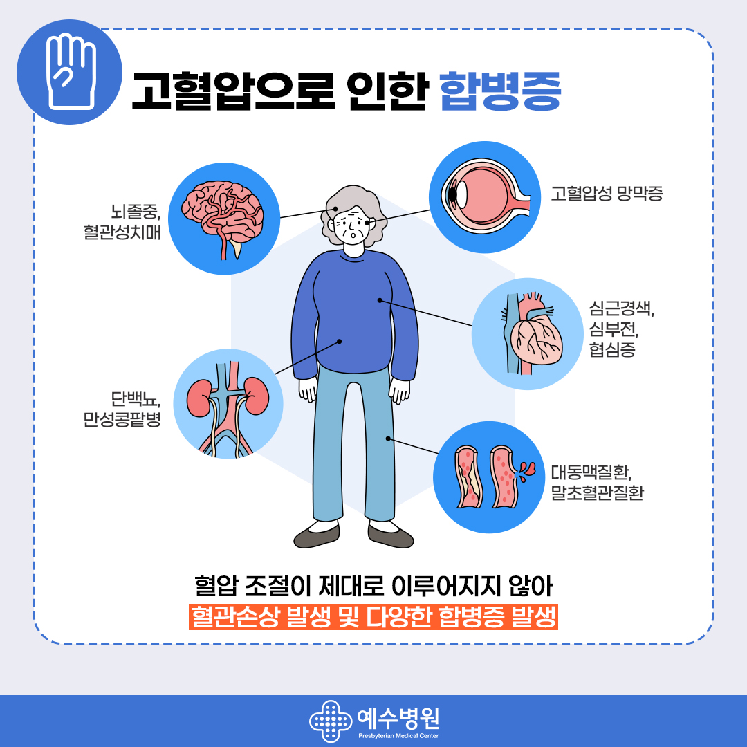 고혈압으로 인한 합병증 뇌졸증, 혈관성치매, 고혈압성 망막증, 심근경색, 심부전,협심증, 단백뇨, 만성콩팥병, 대동맥질환, 말초혈관질환-혈압 조절이 제대로 이루어지지 않아 혈관손상 발생 및 다양한 합병증 발생