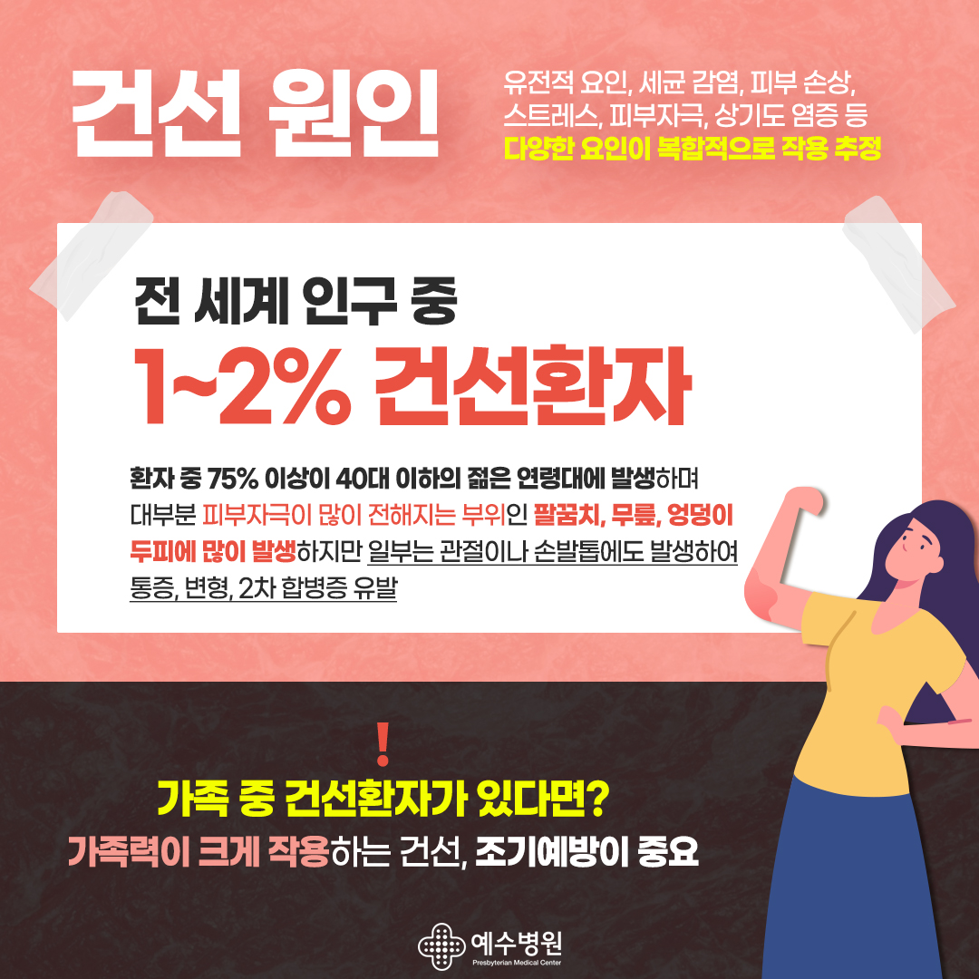 건선 원인 : 유전적 요인, 세균 감염, 피부 손상, 스트레스, 피부자극, 상기도 염증 등 다양한 요인이 복합적으로 작용 추정. 전 세계 인구 중 1~2% 건선환자이며 환자 중 75% 이상이 40대 이하의 젊은 연령대에 발생하며 대부분 피부자극이 많이 전해지는 부위인 팔꿈치, 무플, 엉덩이 두피에 많이 발생하지만 일부는 관절이나 손발톱에도 발생하여 통증, 변형, 2차 합병증 유발. 가족 중 건선환자가 있다면? 가족력이 크게 작용하는 건선, 조기예방이 중요