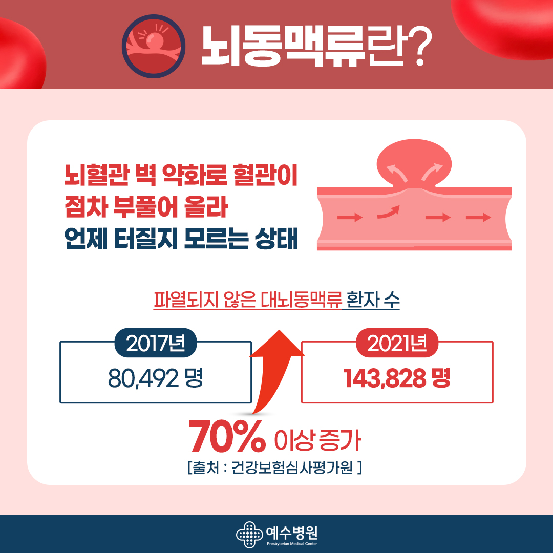 뇌동맥류란? 뇌혈관 벽 약화로 혈관이 점차 부풀어 올라 언제 터질지 모르는 상태. 파열되지 않은 대뇌동맥류 호나자 수. 2017년 80492명, 2021년 143,828명으로 70%이상 증가[출처 : 건강보험심사평가원]