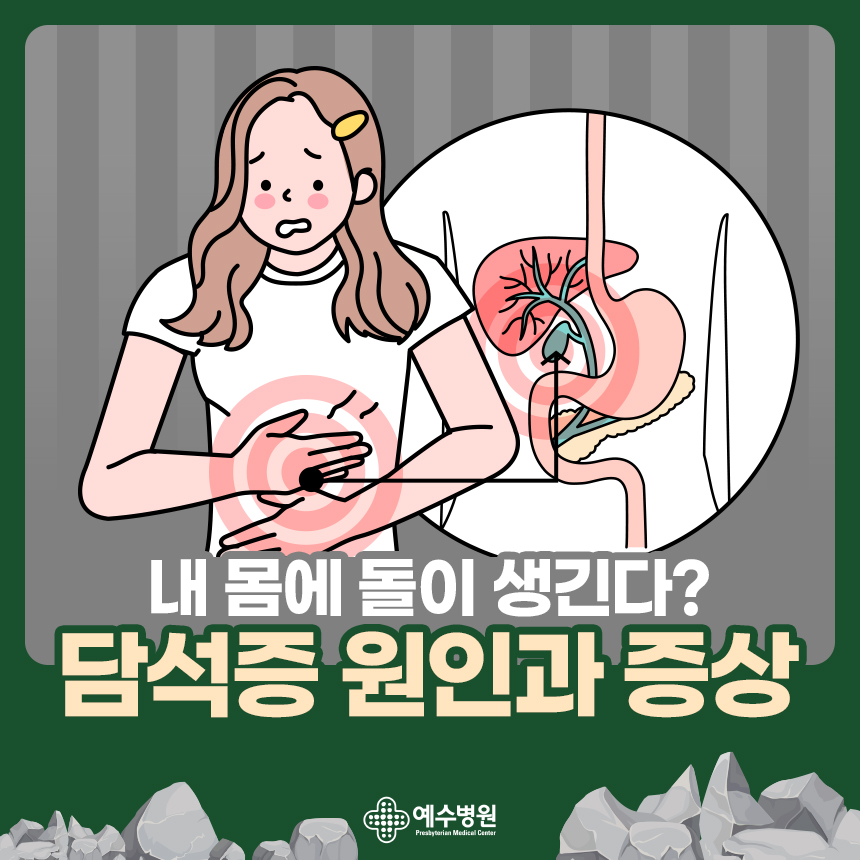 내 몸에 돌이 생긴다? 담석증 원인과 증상