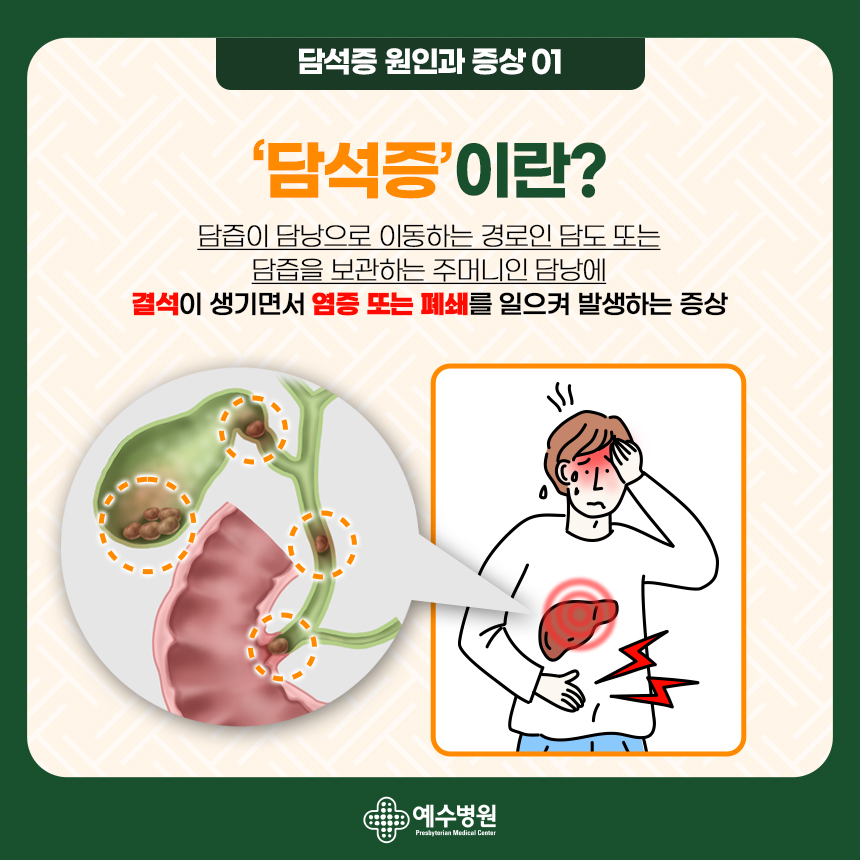 담석증 원인과 증상 01 - 담석증이란? 담즙이 담낭으로 이동하는 경로인 담도 또는 담즙을 보관하는 주머니인 담낭에 결석이 생기면서 염증 또는 폐쇄를 일으켜 발생하는 증상