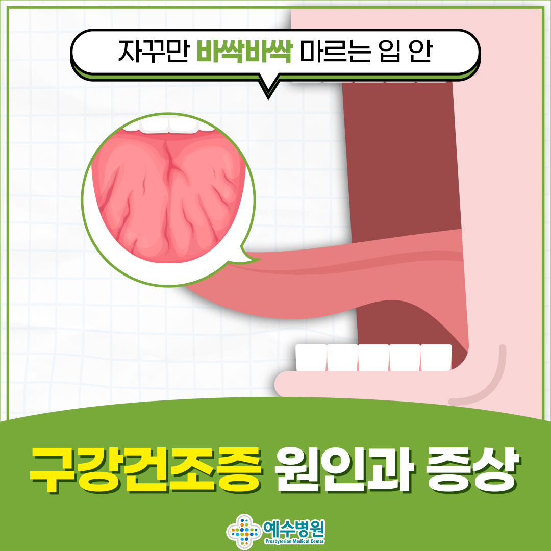 자꾸만 바싹바싹 마르는 입 안 구강건조증 원인과 증상